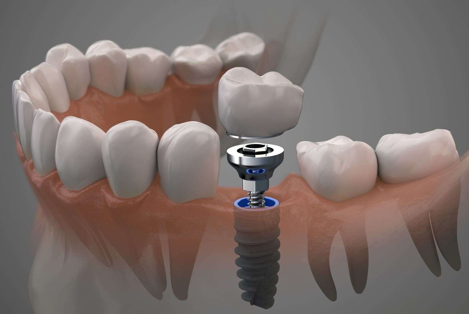 best Dental Implant Treatment in Dhaka