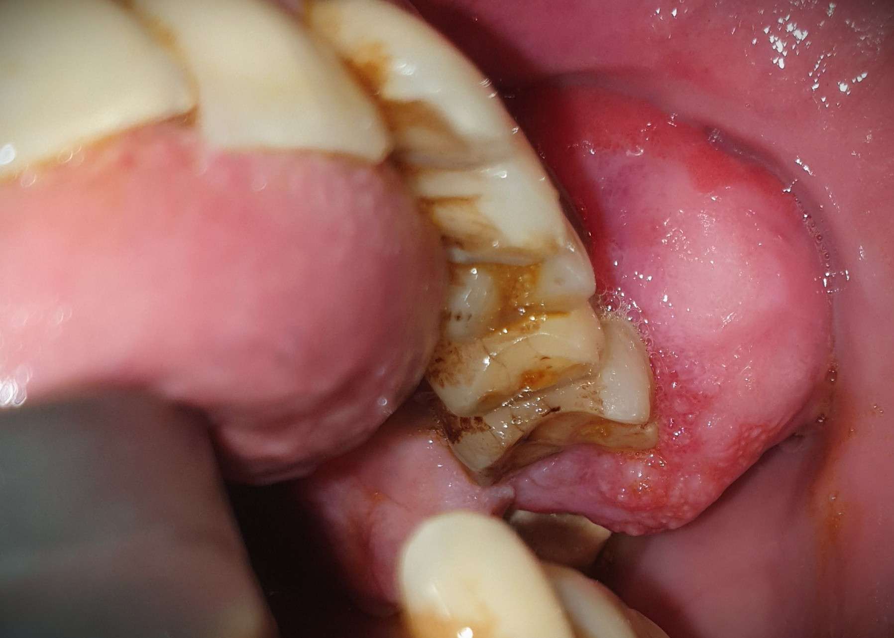 best jaw tumor management in Dhaka