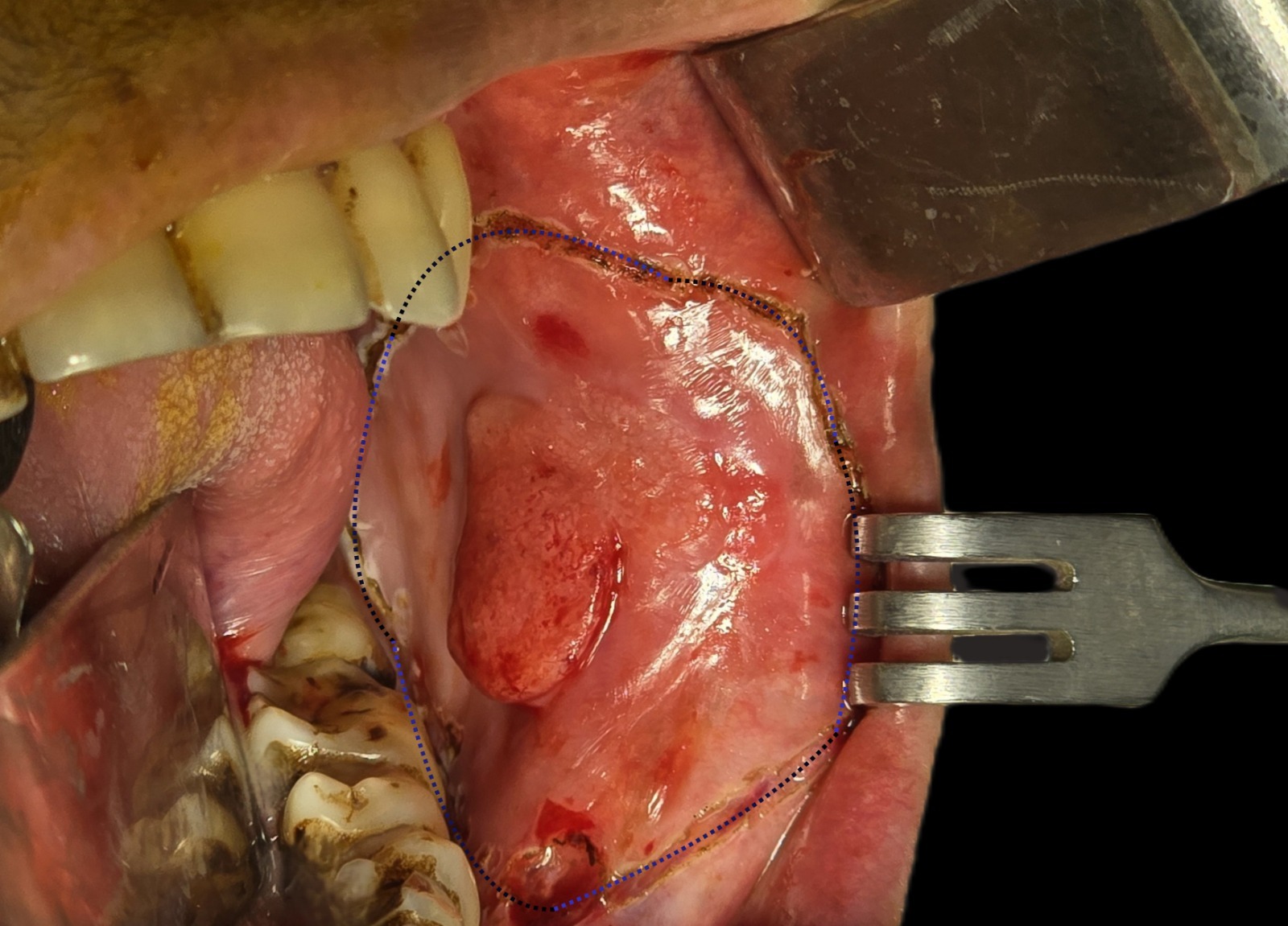 Best Oral Cancer Surgeon in bangladesh